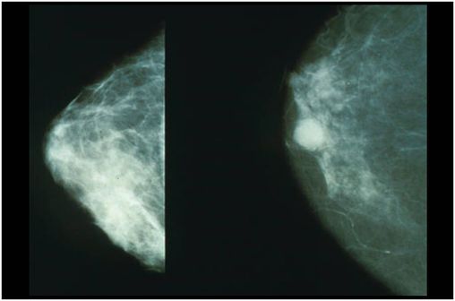 Mammographie montrant un cancer du sein sur le cliché de droite (illustration @ Wikimedia).