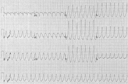 Tracé électrocardiographique montrant une tachycardie ventriculaire (illustration @Karthik Sheka, M.D., sur Wikimedia).