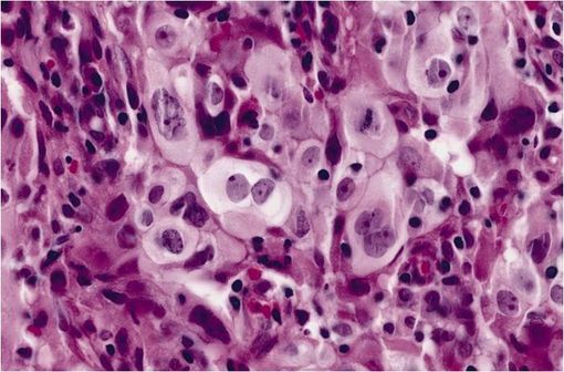 Carcinome pulmonaire à grandes cellules, un sous-type de carcinome pulmonaire non à petites cellules (illustration @AFIP, sur Wikimedia).