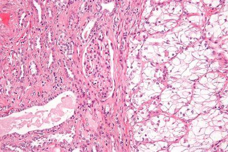 Micrographie d'un carcinome rénal, à la droite de l'image ; le rein non tumoral est à la gauche de l'image (© Nephron, Wikimedia).
