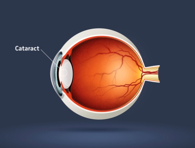 La cataracte la plus fréquente est dûe au vieillissement et survient généralement après l'âge de 50 ans.