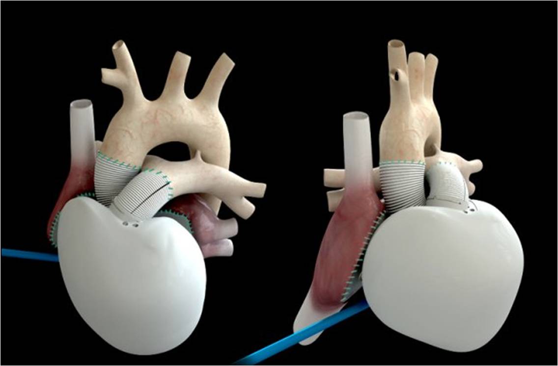 Le coeur artificiel développé par le Pr Carpentier et son équipe est implanté sur les oreillettes (© Carmat SA)