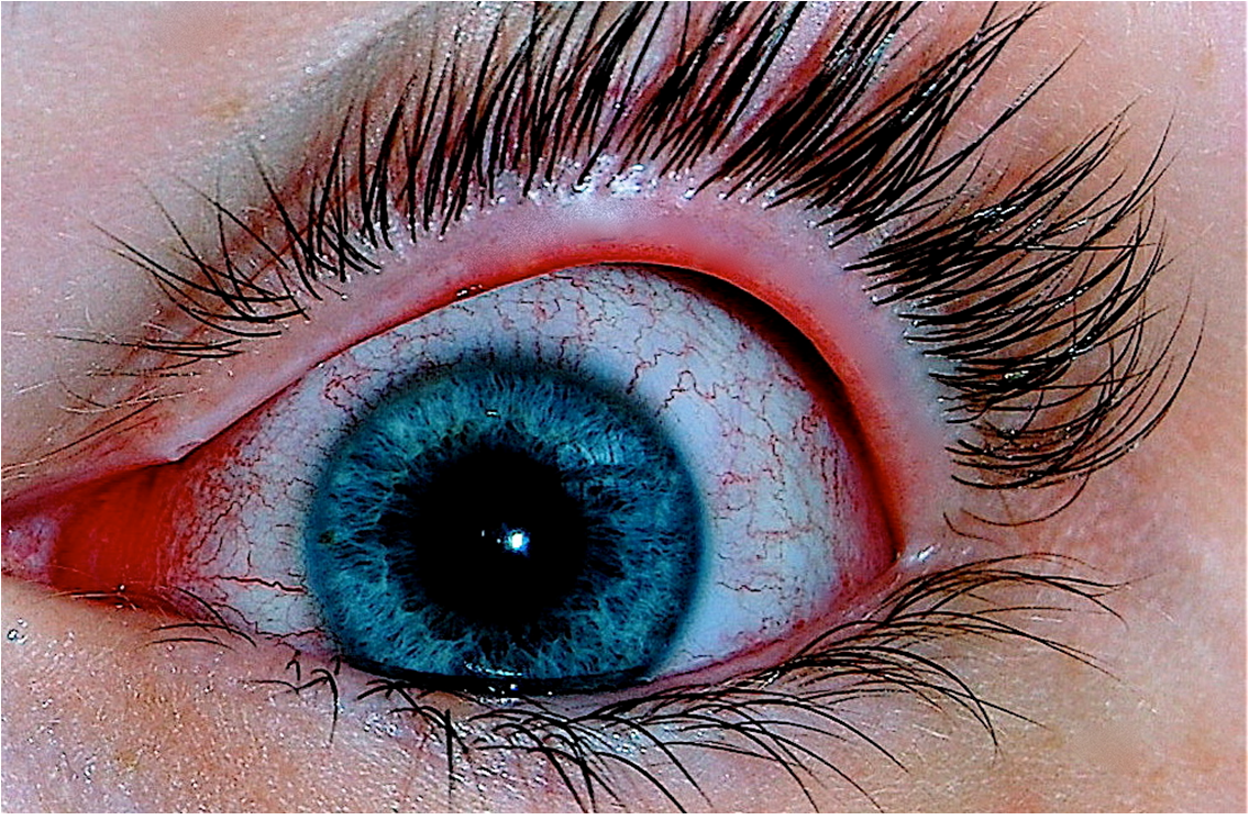 Oeil humain présentant une conjonctivite (photo @ Joyhill09 - Wikimedia).