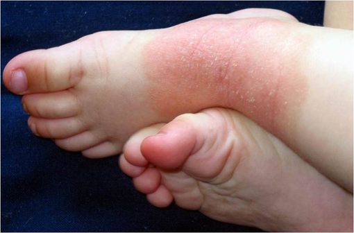 Lésions de dermatite atopique chez un enfant (illustration @Bernd Untiedt sur Wikimedia).