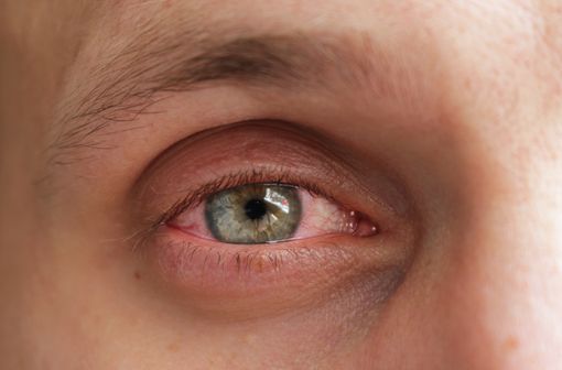 Les corticoïdes et en particulier la dexaméthasone restent indispensables pour traiter les pathologies inflammatoires sévères de la surface oculaire (illustration).