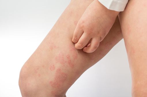 Lésions de dermatite atopique sur les jambes d'un enfant (illustration).