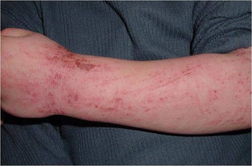 Lésions de dermatite atopique (illustration @Eisfelder sur Wikimedia).