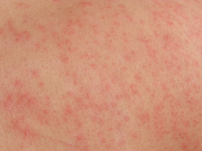 Les mécanismes d'action des dermites d'irritation sont multiples et les tests diagnostiques rares.