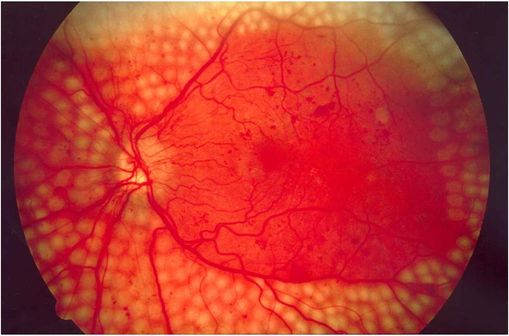 Points de coagulation laser dans le traitement de la rétinopathie diabétique (illustration @National Eye Institute, National Institutes of Health sur Wikimedia).