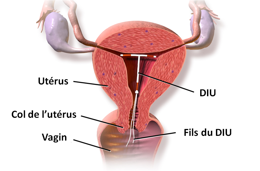 En 3 ans, deux fois plus de jeunes femmes ont opté pour un dispositif intra-utérin (illustration : © BruceBlaus, Wikimedia Commons). 