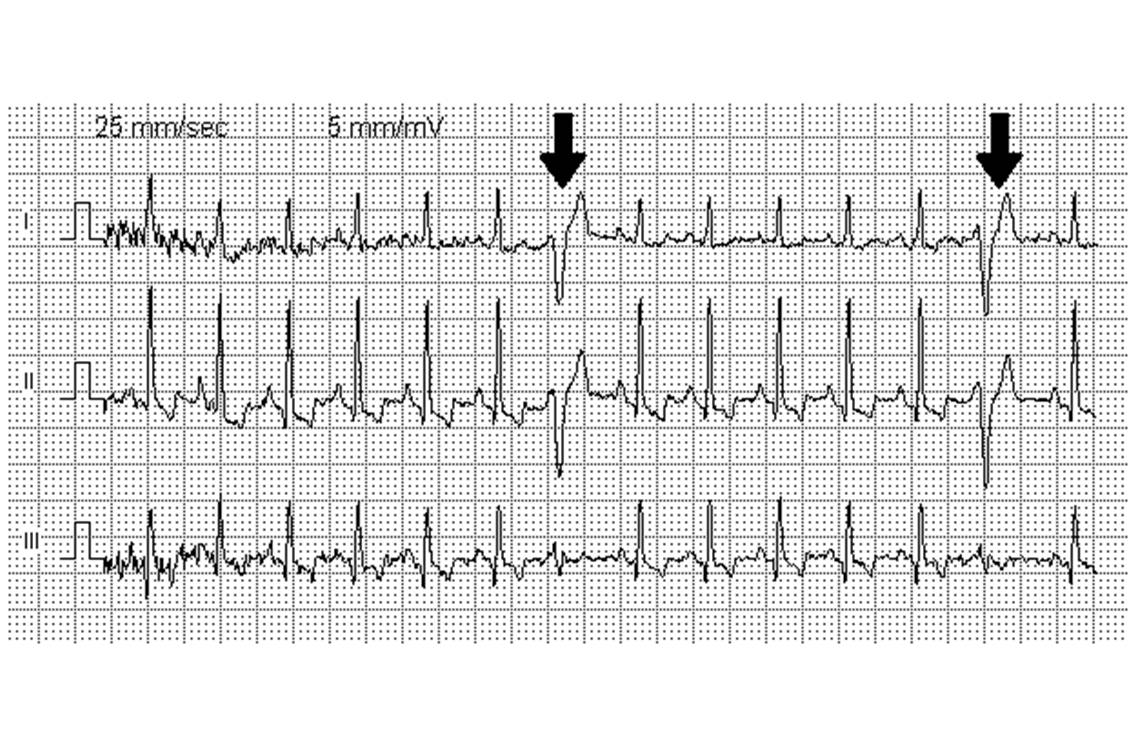 Extrasystoles ventriculaires sur un tracé ECG (cliché : @ Kalumet, Wikimedia).