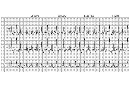Tracé ECG de tachycardie (photo @ Kalumet sur Wikimedia).