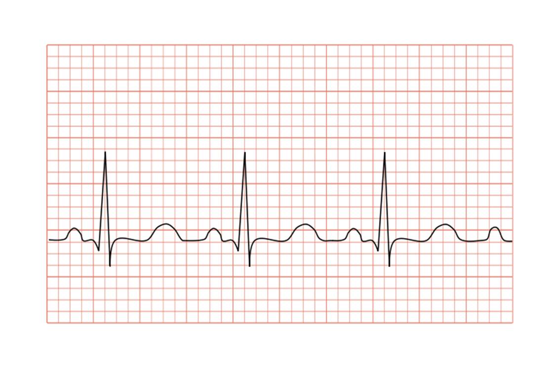 ECG montrant une tachycardie sinusale avec un rythme de 100 battements par minute (@ Madhero88, Wikimedia)