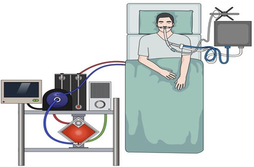 Une technique d'assistance respiratoire qui ne peut être mise en place que par des équipes spécialisées (illustration).