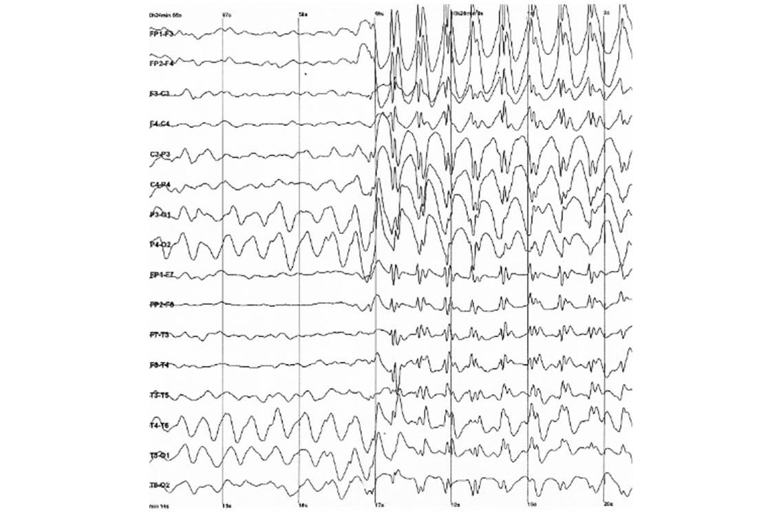 Tracé typique d'une crise d'épilepsie à l'électroencéphalogramme (@ Wikimedia).