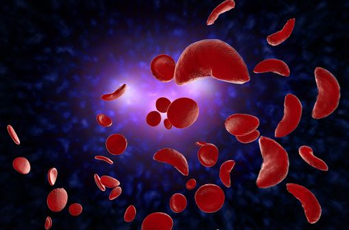 Représentation en 3D de globules rouges d'un malade atteint de drépanocytose, encore appelée anémie à cellules falciformes (illustration).