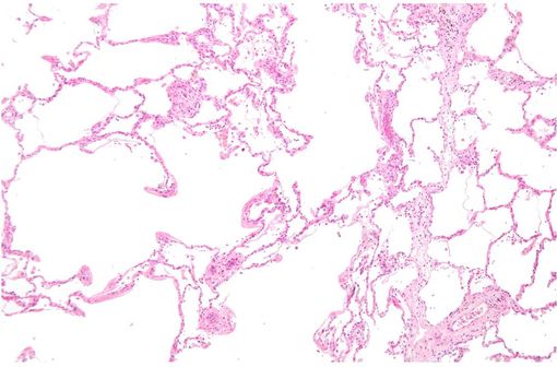 Vue micrographique de tissu pulmonaire montrant des lésions emphysémateuses (à gauche) et un tissu alvéolaire relativement préservé (à droite) [photo @ Nephron sur Wikimedia].
