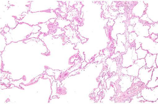 Lésions d'emphysème (à gauche) et alvéoles relativement préservées (à droite) sur une vue microscopique de tissu pulmonaire (photo @ Nephron sur Wikimedia).