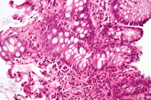 Microphotographie montrant des lésions de maladie inflammatoire de l'intestin (illustration).
