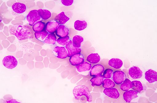 La leucémie aiguë lymphoblastique est provoquée par la multiplication de lymphocytes défaillants dans la moelle osseuse appelés blastes (illustration).