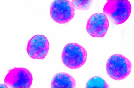 La leucémie aiguë lymphoblastique est provoquée par la multiplication de lymphocytes défaillants dans la moelle osseuse appelés blastes (illustration).