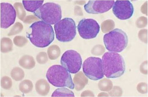 La leucémie aigüe lymphoblastique est provoquée par la multiplication de lymphocytes défaillants dans la moelle osseuse, appelés blastes (illustration @VashiDonsk sur Wikipedia anglais).
