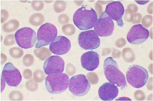 Blastes de cellules B sur un prélèvement de moelle osseuse chez un patient atteint de leucémie aiguë lymphoblastique (illustration @VashiDonsk sur Wikimedia).
