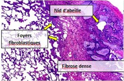 La fibrose pulmonaire idiopathique est caractérisée par la formation de tissu cicatriciel dans les poumons en l'absence de toute cause connue (illustration @IPFeditor  sur Wikimedia).