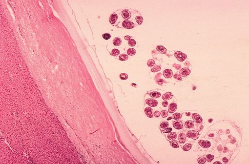 Histopathologie (chez un mouton) de kystes hydatiques d'Echynococcus granulosus (illustration @phil CDC sur Wikimedia).