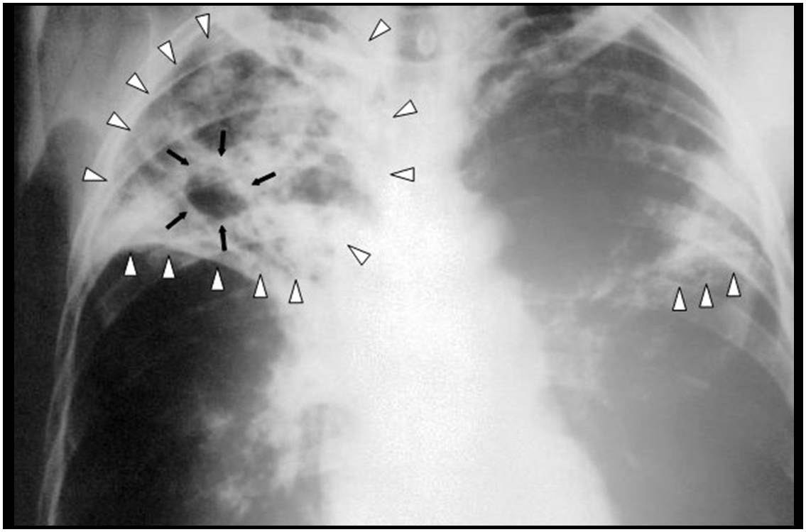 Radiographie thoracique d'un patient atteint d'une tuberculose à un stade avancé touchant les poumons de façon bilatérale (illustration @Wikimedia). width=