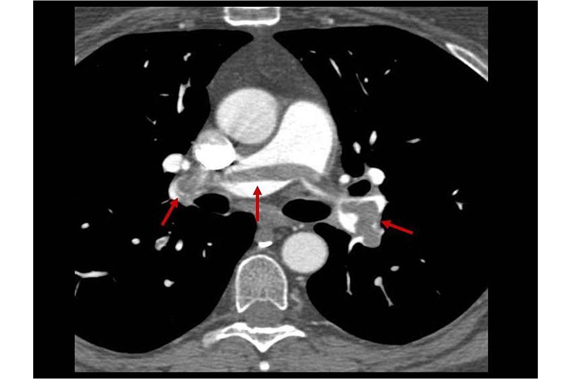 Scanner montrant une embolie dans les artères pulmonaires centrales (embolie dite en selle) (© Carl Chartrand-Lefebvre, Wikimedia).