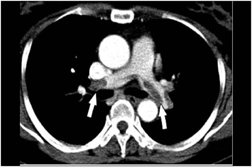 Scanner thoracique montrant de nombreuses lacunes dans les principales branches des artères pulmonaires lors d'une embolie pulmonaire (photo @ Wikimedia).