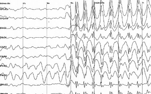 Les crises d'épilepsie se traduisent par une activité caractéristique à l'électro-encéphalogramme (© Der Lange, Wikipedia).