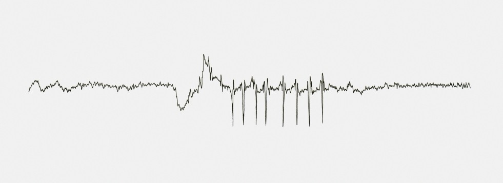 L'EEG est l'examen clé du diagnostic d'épilepsie