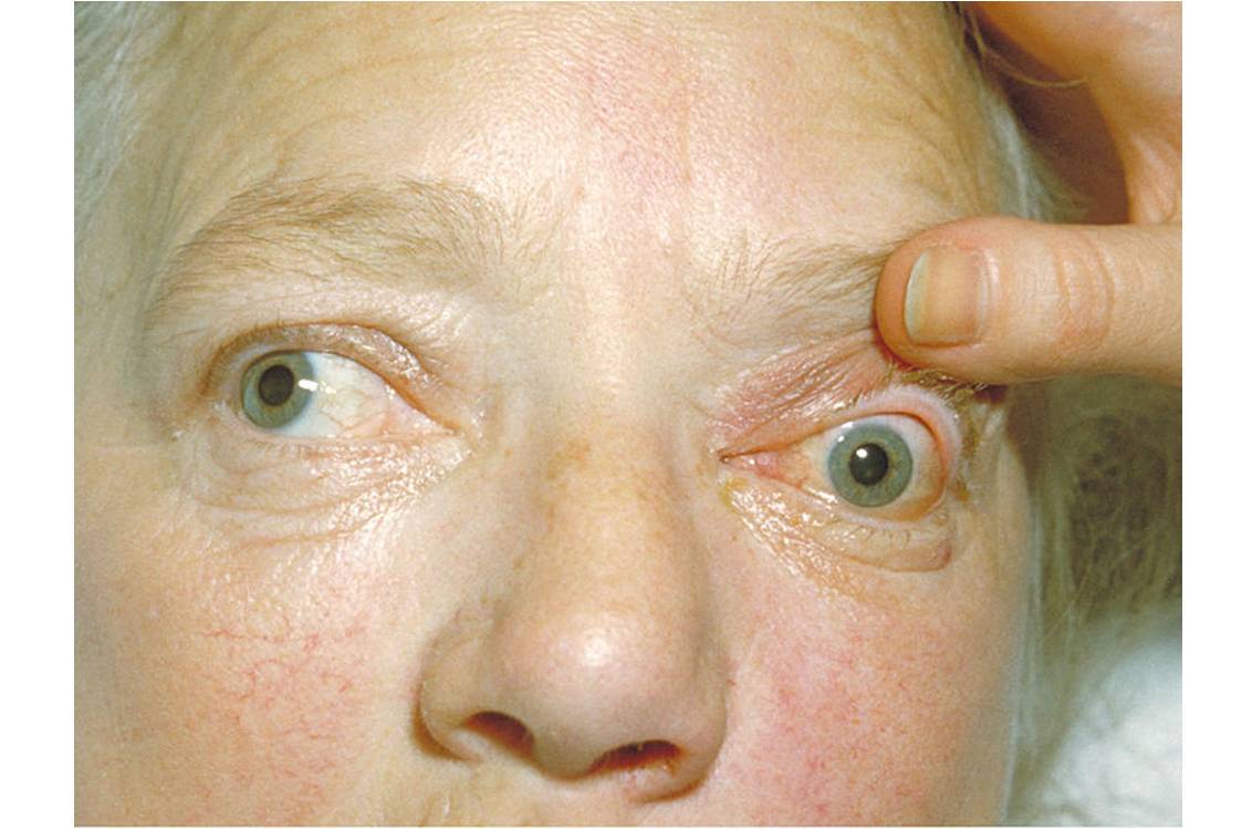 Exophtalmie bilatérale, un des signes de la maladie de Basedow (image : @ CDC/Dr. Sellers/Emory University, Wikimedia)