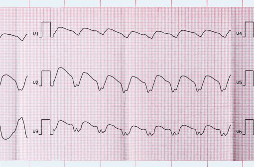 Tracé ECG d'une tachycardie ventriculaire paroxystique (illustration).