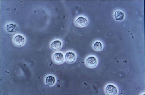 Vue microscopique d'une bactériurie avec pyurie (illustration @Steven Fruitsmaak - Eigenes Werk, sur Wikimedia).
