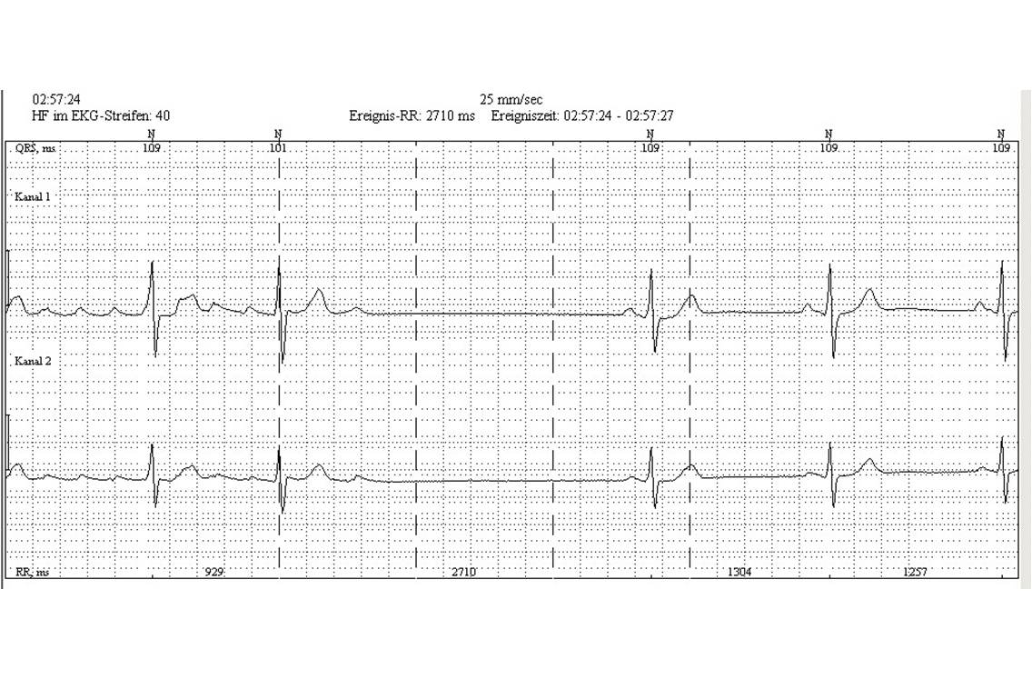 Holter cardiaque : flutter atrial (à gauche) avec retour en rythme sinusal (cliché : @ J. Heuser, Wikimedia).