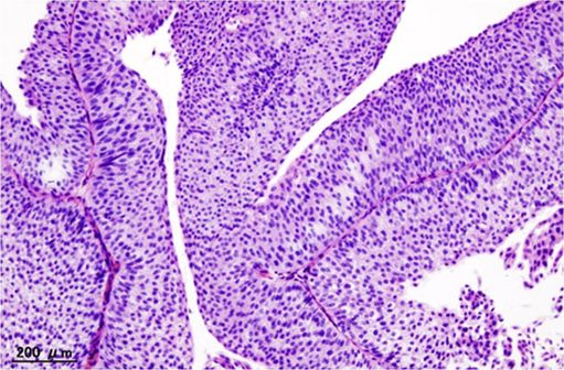 Histopathologie d'un carcinome urothélial de la vessie (illustration @Wikimedia).