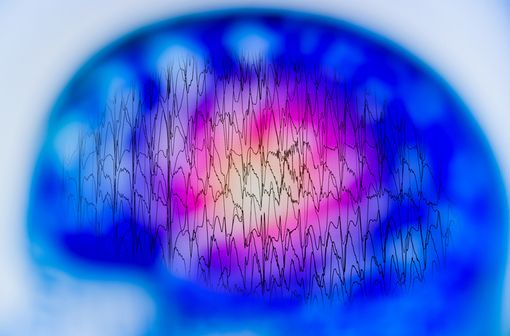 Les crises épileptiques consistent en un fonctionnement excessif et simultané des neurones, à l’origine de décharges électriques soudaines (illustration). 