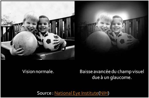 Maladie dégénérative du nerf optique, le glaucome entraîne une perte progressive de la vision commençant en périphérie et progressant graduellement vers le centre (cliché @ Wikimedia).
