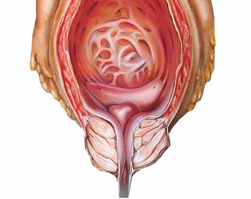 Hypertrophie bénigne de la prostate (dessin).