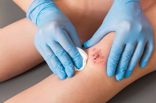 HEXOMEDINE est indiqué dans le traitement d'appoint des affections de la peau primitivement bactériennes ou susceptibles de se surinfecter (illustration).