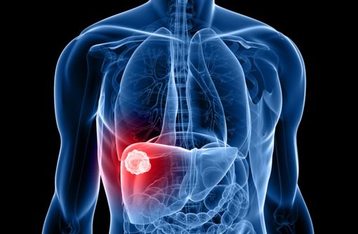 Un cancer du foie peut survenir chez 3 à 10 % des patients atteints d'une hépatite C chronique au stade cirrhose (illustration). 