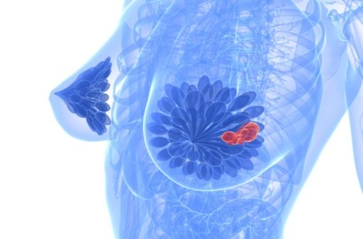 IBRANCE est indiqué dans la prise en charge du cancer du sein localement avancé ou métastatique, RH+ et HER2-négatif (illustration).