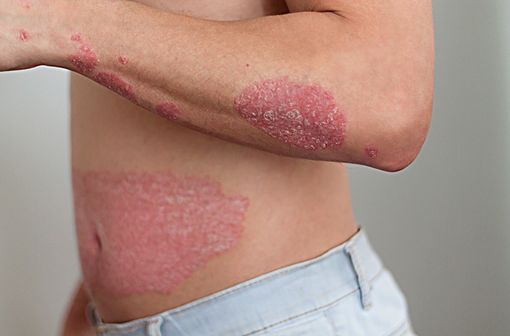 Le psoriasis en plaques se traduit par l’apparition de plaques rouges souvent irritantes et d’une accumulation de squames qui peuvent se situer sur tout le corps (illustration).