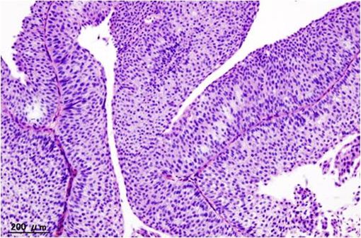 Coupe histologique d'un carcinome urothélial de vessie de grade T1a (illustration @Wikimedia).