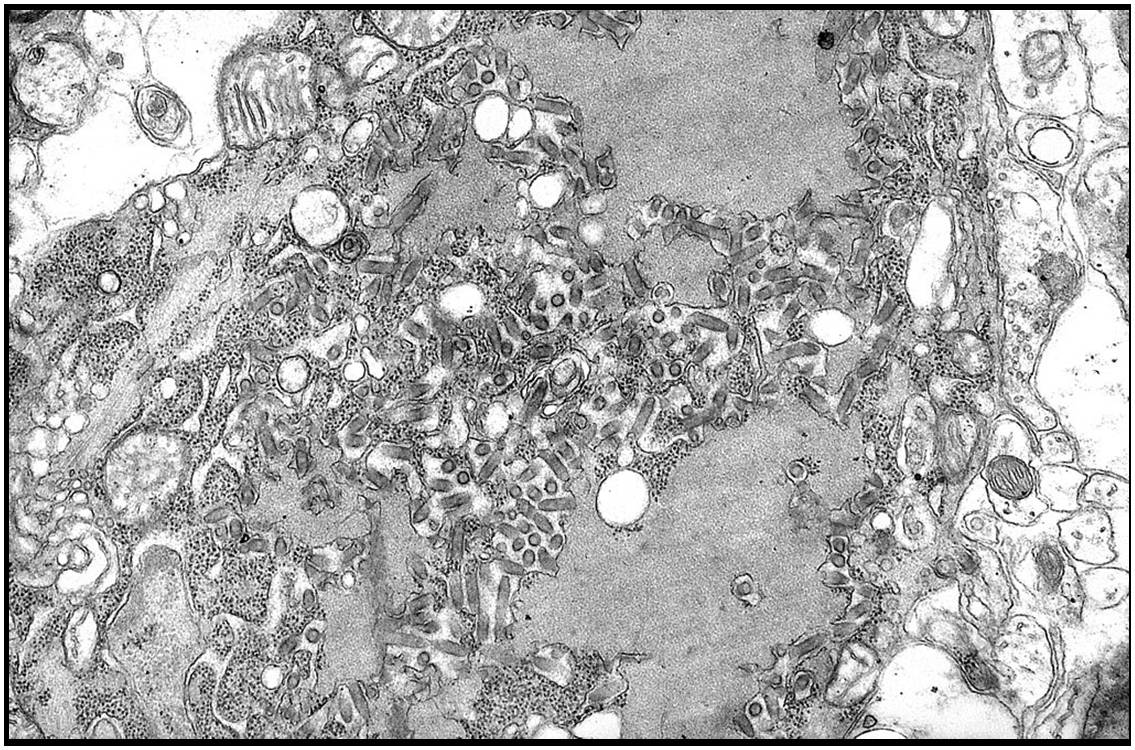 Micrographie montrant de nombreux virions de la rage (petits bâtonnets gris sombre) et des corps de Negri (inclusions cellulaires plus larges pathognomoniques de la rage (illustration @Wikimedia).
