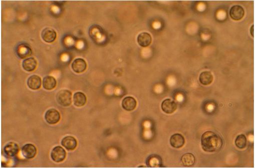 Globules blancs dans l'urine d'un patient atteint d'une infection urinaire (illustration @ Bobjgalindo sur Wikimedia).