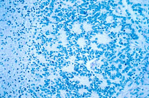 Vue microscopique d'un neuroblastome typique avec formation de rosettes (Dr Maria Tsokos, National Cancer Institute, @Wikimedia).
